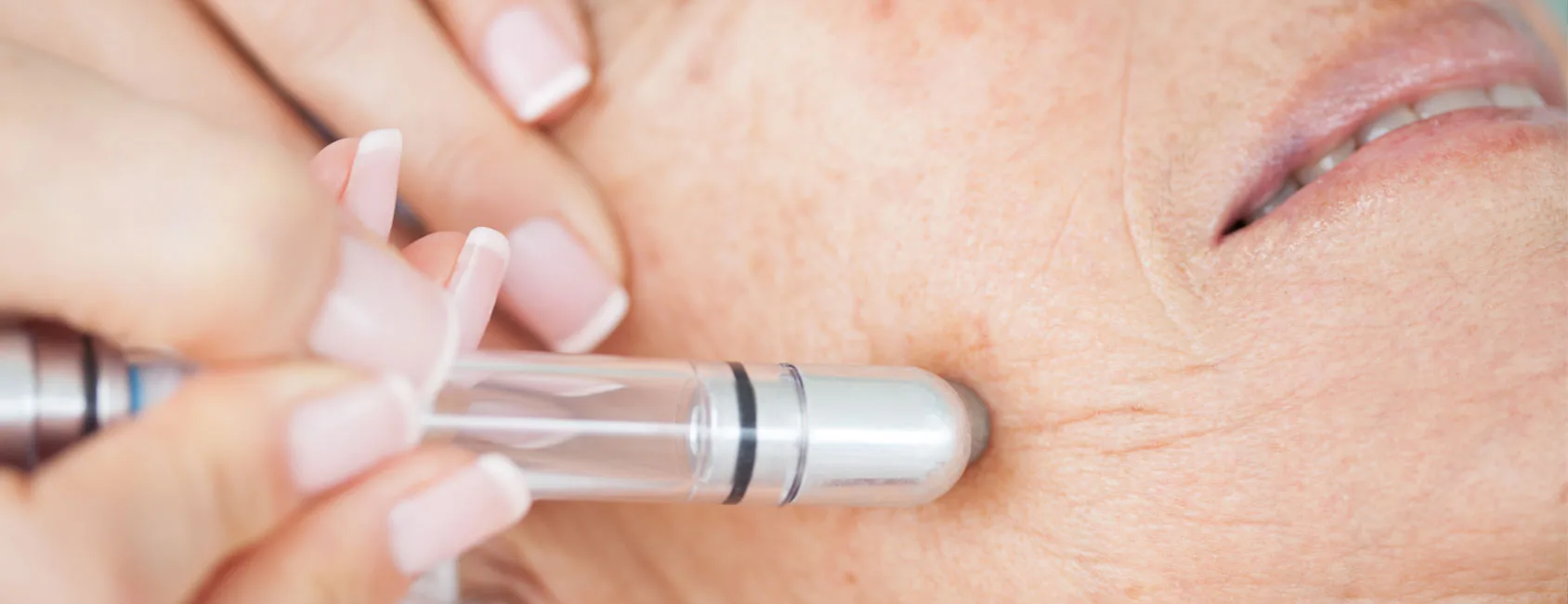 Diamond-tip microdermabrasion wand on mature facial skin