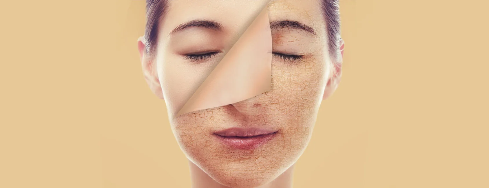 Chemical skin peel treatment