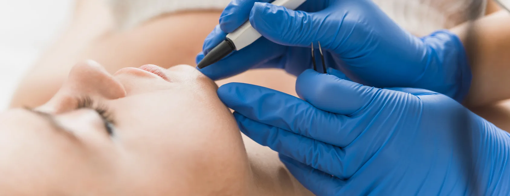 Electrolysis permanent hair removal treatment in progress