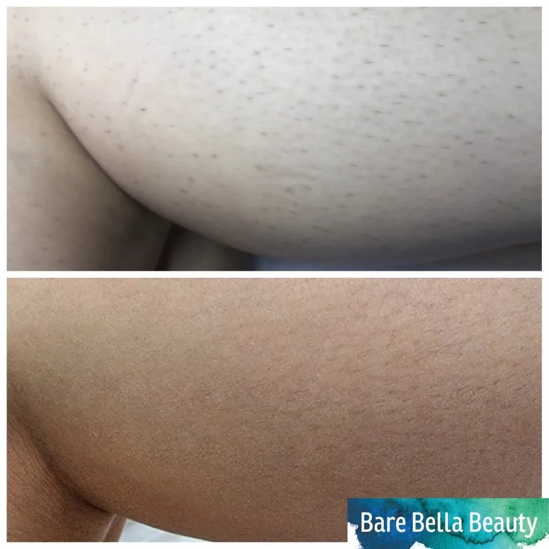 IPL hair removal before and after result