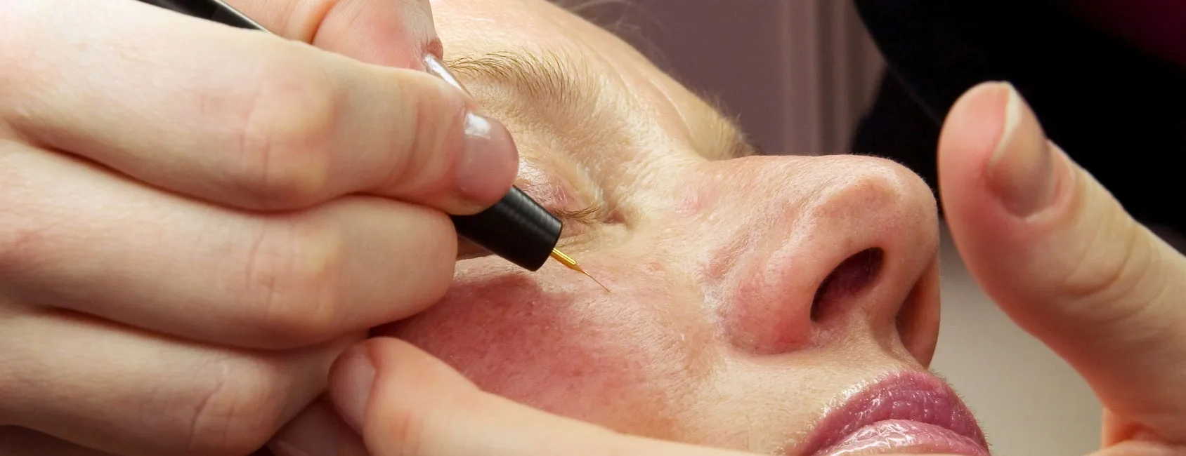 Diathermy red vein removal treatment on facial skin