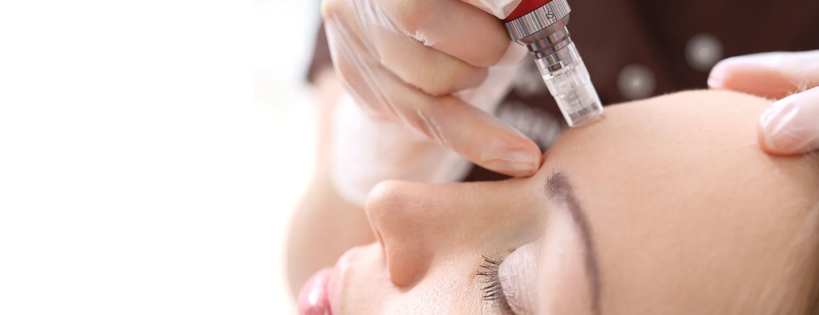 Skin needling collagen induction therapy treatment on a face